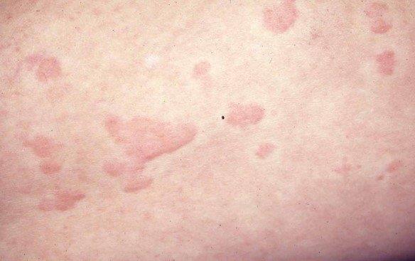 楊浩康(Yeung Ho Hong)醫生講解慢性蕁麻疹